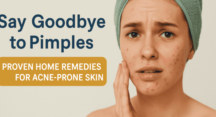 Home Remedies for Acne