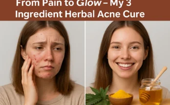 Herbal Acne Cream